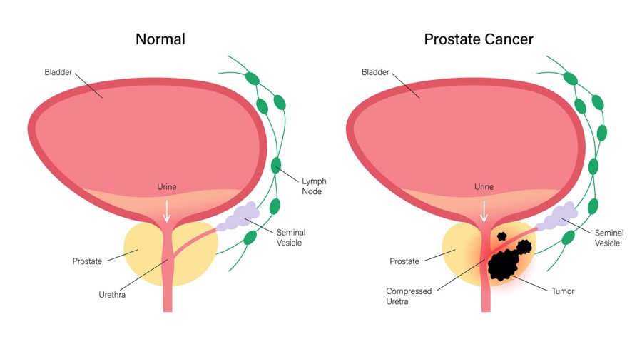 Healthy prostate gland Vs prostate cancer showing the need of prostate cancer screening for men