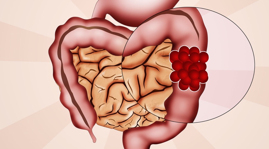 A diagram of a human digestive system showing bowel cancer in the food colon showing the need of bowel cancer screening for men