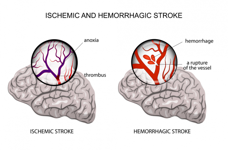 Hemorrhagic stroke graphic